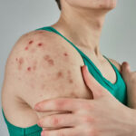 چطور اگزما را کنترل کنیم؟ | علت، علائم و بهترین روش‌های درمان اگزما